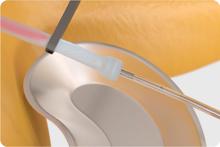 AVAS Occluder Insertion