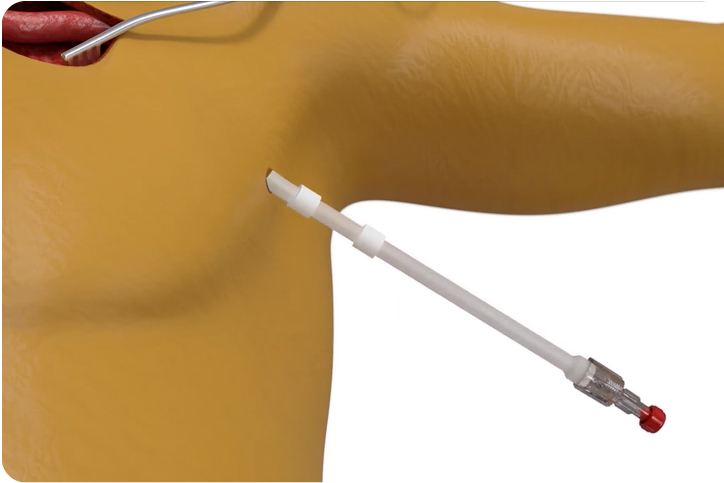 Explantation Procedure